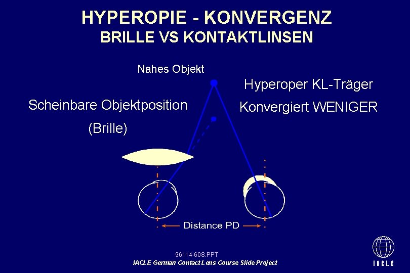 HYPEROPIE - KONVERGENZ BRILLE VS KONTAKTLINSEN Nahes Objekt Hyperoper KL-Träger Scheinbare Objektposition Konvergiert WENIGER