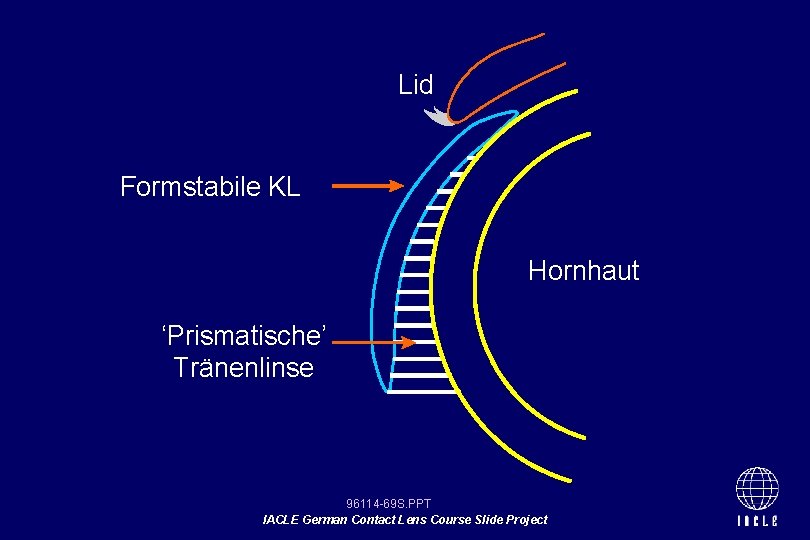 Lid Formstabile KL Hornhaut ‘Prismatische’ Tränenlinse 96114 -69 S. PPT IACLE German Contact Lens