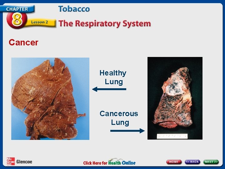 Cancer Healthy Lung Cancerous Lung 