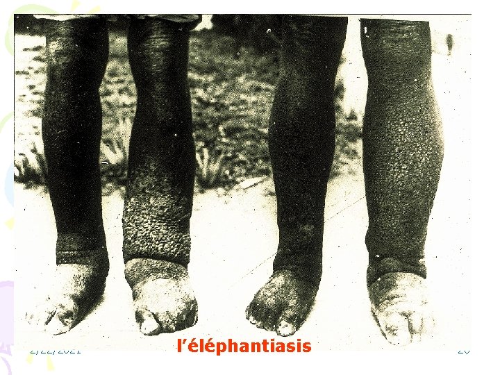 2/22/2021 l’éléphantiasis 26 