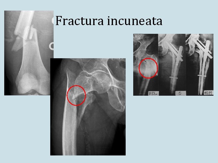 Fractura incuneata 