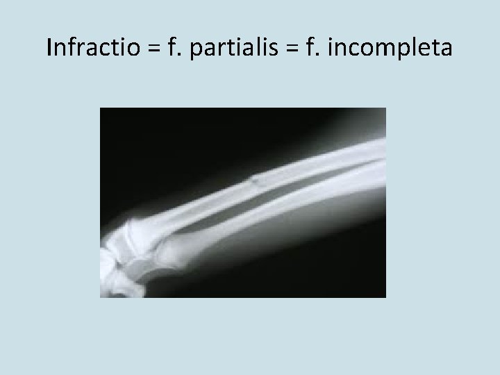 Infractio = f. partialis = f. incompleta 