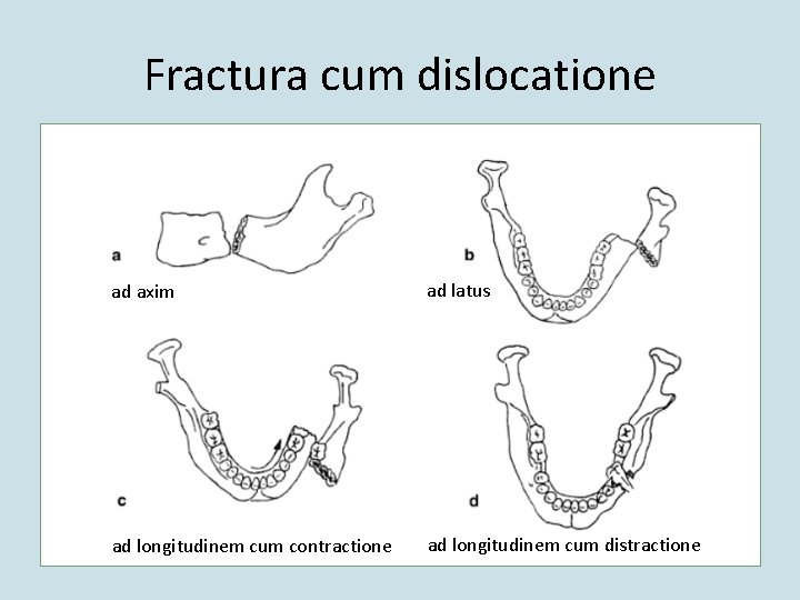 Fractura cum dislocatione ad axim ad latus ad longitudinem cum contractione ad longitudinem cum