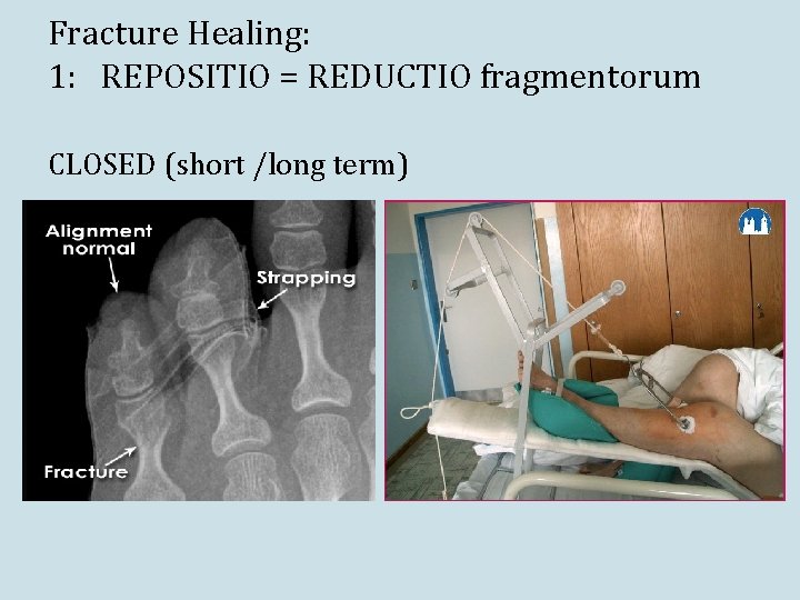 Fracture Healing: 1: REPOSITIO = REDUCTIO fragmentorum CLOSED (short /long term) Fracture Healing: 1: REPOSITIO = REDUCTIO fragmentorum CLOSED (short /long term)
