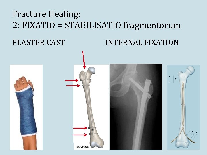 Fracture Healing: 2: FIXATIO = STABILISATIO fragmentorum PLASTER CAST INTERNAL FIXATION 