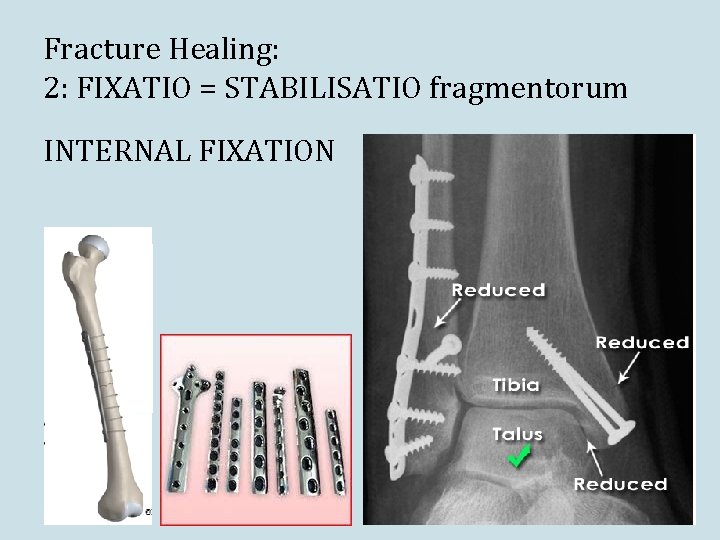 Fracture Healing: 2: FIXATIO = STABILISATIO fragmentorum INTERNAL FIXATION Fracture Healing: 2: FIXATIO = STABILISATIO fragmentorum INTERNAL FIXATION