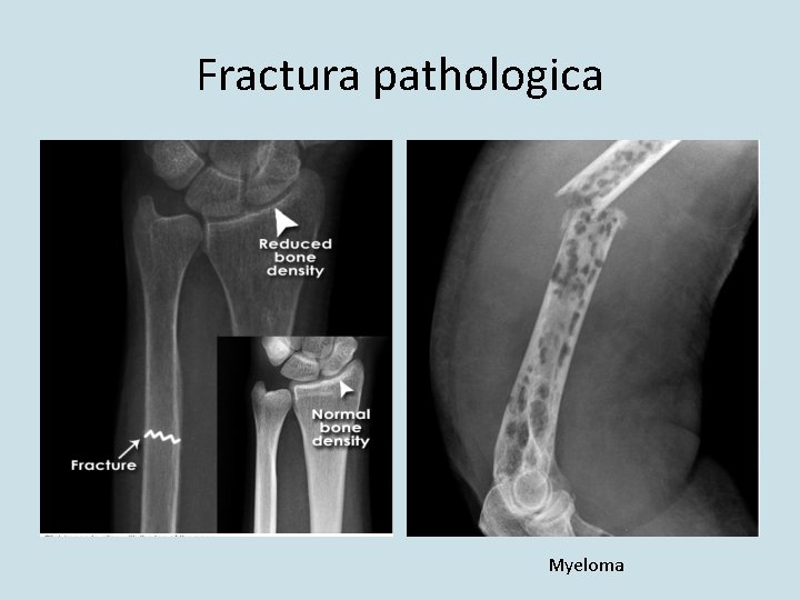 Fractura pathologica Myeloma 