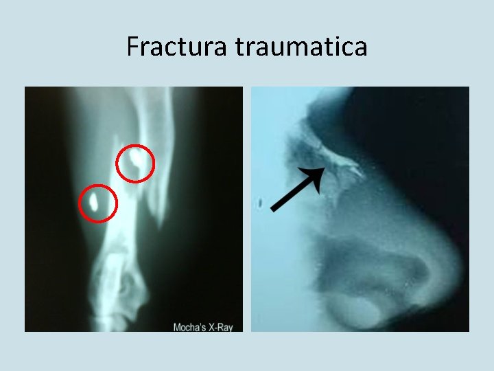 Fractura traumatica Fractura traumatica