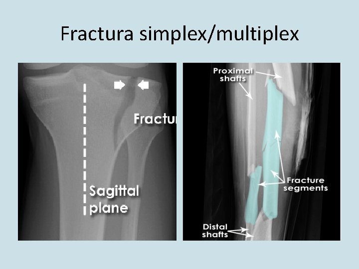 inflamația epicondilitei articulației cotului unguent pentru forum dureri articulare