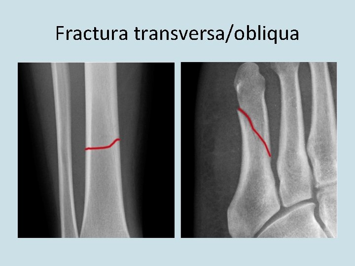 Fractura transversa/obliqua Fractura transversa/obliqua