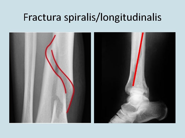 Fractura spiralis/longitudinalis 