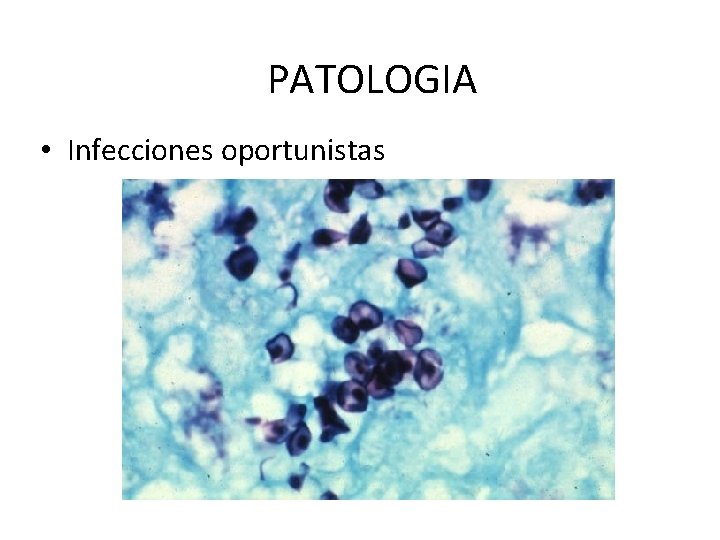 PATOLOGIA • Infecciones oportunistas 