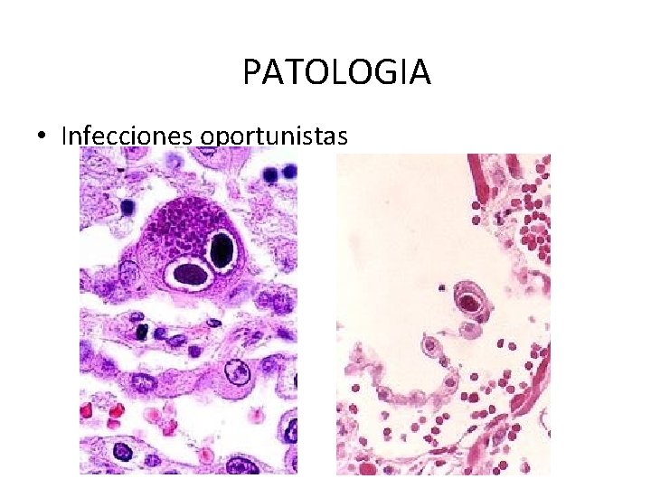 PATOLOGIA • Infecciones oportunistas 