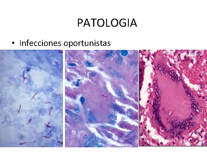 PATOLOGIA • Infecciones oportunistas 
