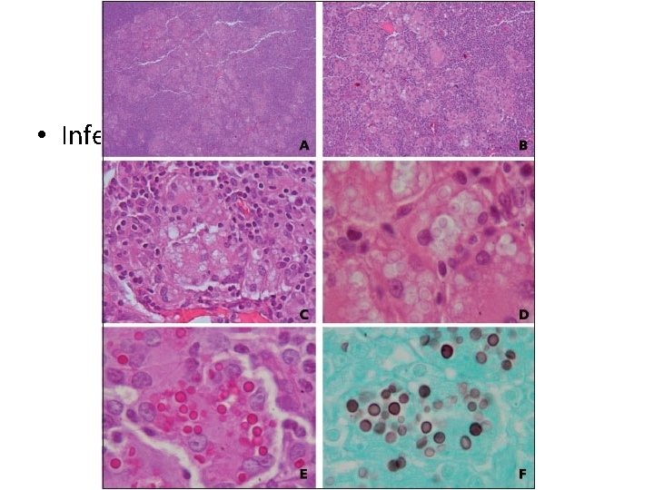 PATOLOGIA • Infecciones oportunistas 