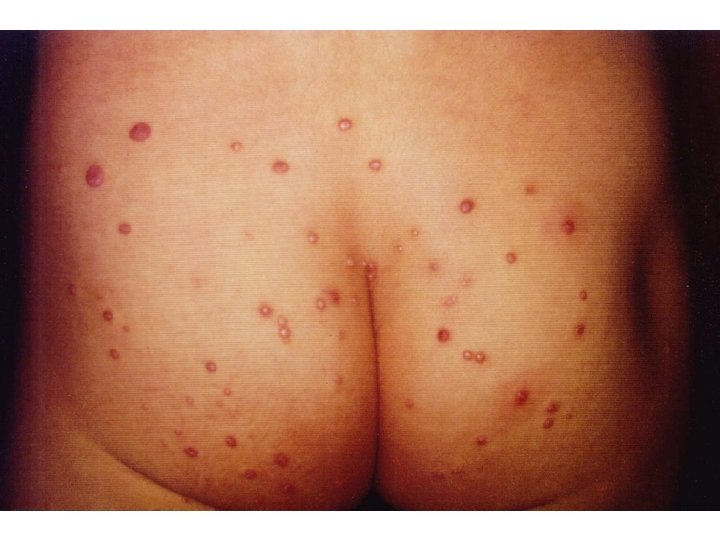 PATOLOGIA • Infecciones oportunistas 