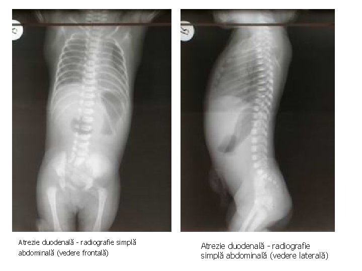 Atrezie duodenală - radiografie simplă abdominală (vedere frontală) Atrezie duodenală - radiografie simplă abdominală