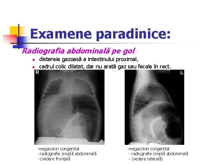 Examene paradinice: Radiografia abdominală pe gol n n distensie gazoasă a intestinului proximal, cadrul