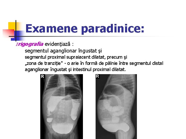 Examene paradinice: Irigografia evidenţiază : segmentul aganglionar îngustat şi segmentul proximal supraiacent dilatat, precum