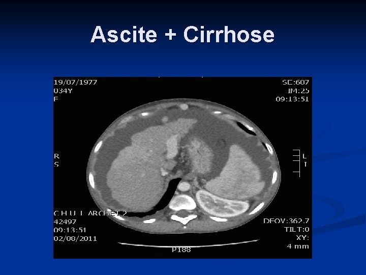 Ascite + Cirrhose 