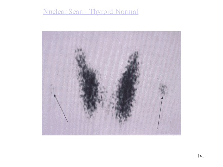 Nuclear Scan - Thyroid-Normal 141 