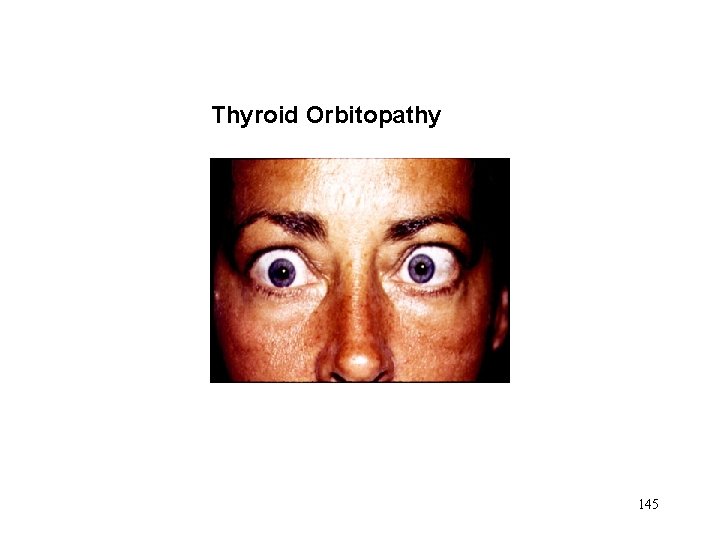 Thyroid Orbitopathy 145 