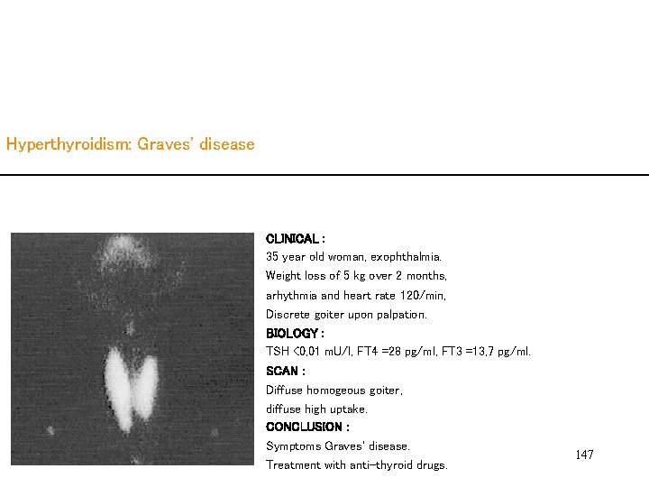 Hyperthyroidism: Graves' disease CLINICAL : 35 year old woman, exophthalmia. Weight loss of 5