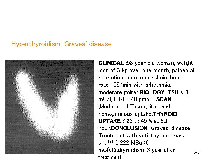 Hyperthyroidism: Graves' disease CLINICAL : 58 year old woman, weight CLINICAL : loss kgweight