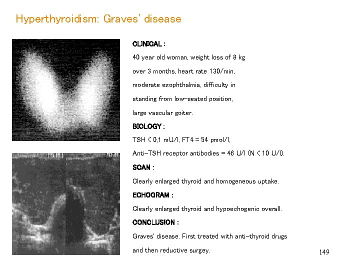 Hyperthyroidism: Graves' disease CLINICAL : 40 year old woman, weight loss of 8 kg