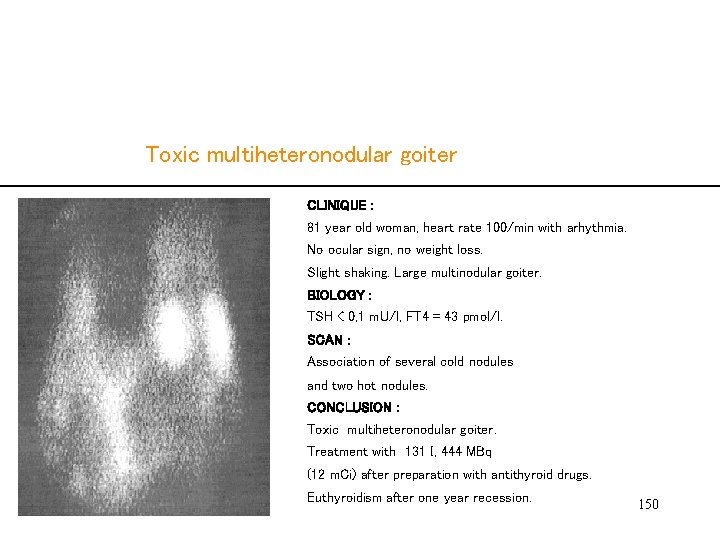  Toxic multiheteronodular goiter CLINIQUE : 81 year old woman, heart rate 100/min with