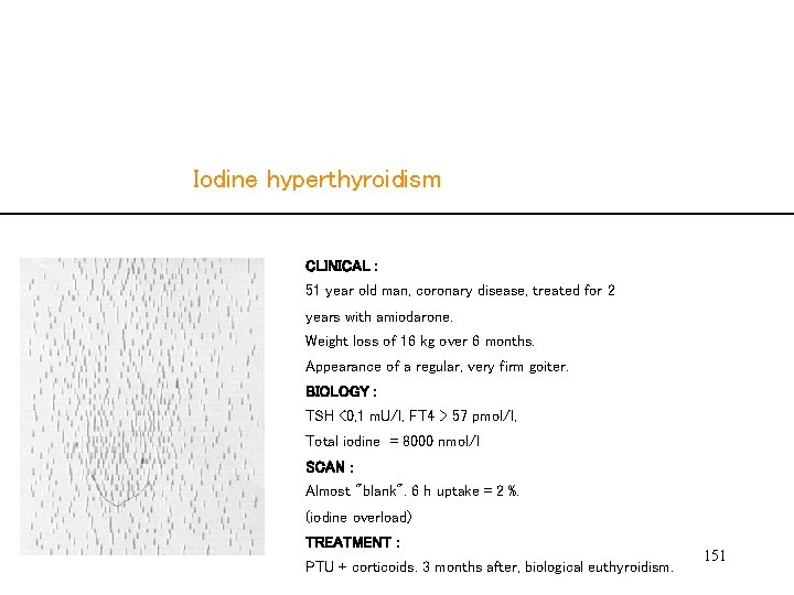  Iodine hyperthyroidism CLINICAL : 51 year old man, coronary disease, treated for 2