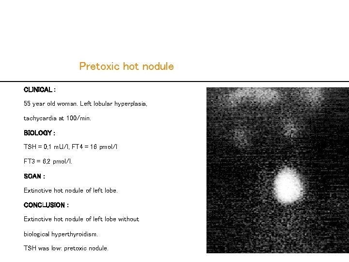  Pretoxic hot nodule CLINICAL : 55 year old woman. Left lobular hyperplasia, tachycardia