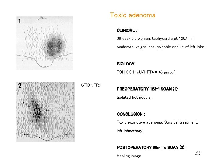  Toxic adenoma CLINICAL : 36 year old woman, tachycardia at 120/min, moderate weight