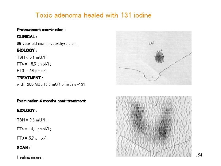  Toxic adenoma healed with 131 iodine Pretreatment examination : CLINICAL : 69 year