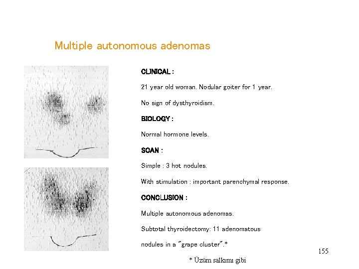  Multiple autonomous adenomas CLINICAL : 21 year old woman. Nodular goiter for 1