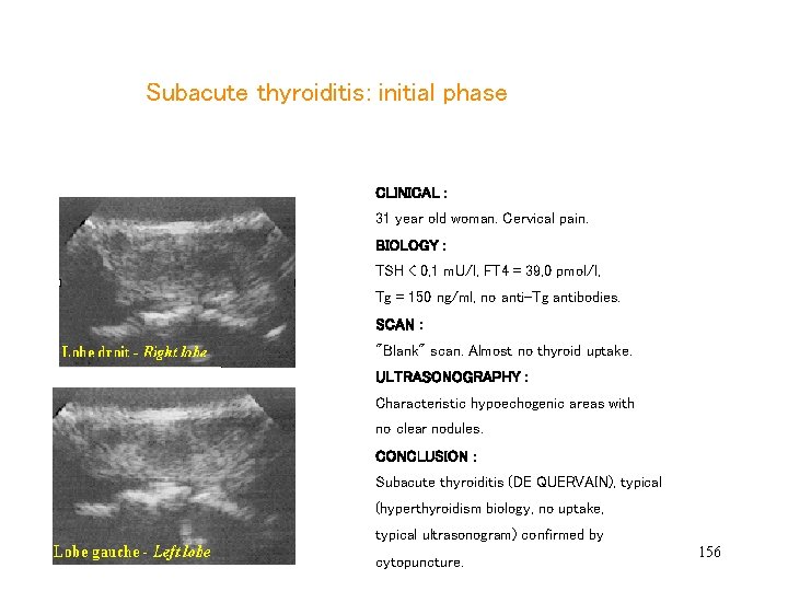  Subacute thyroiditis: initial phase CLINICAL : 31 year old woman. Cervical pain. BIOLOGY