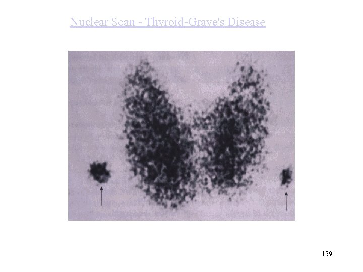 Nuclear Scan - Thyroid-Grave's Disease 159 