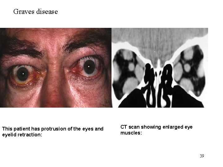 Graves disease This patient has protrusion of the eyes and eyelid retraction: CT scan