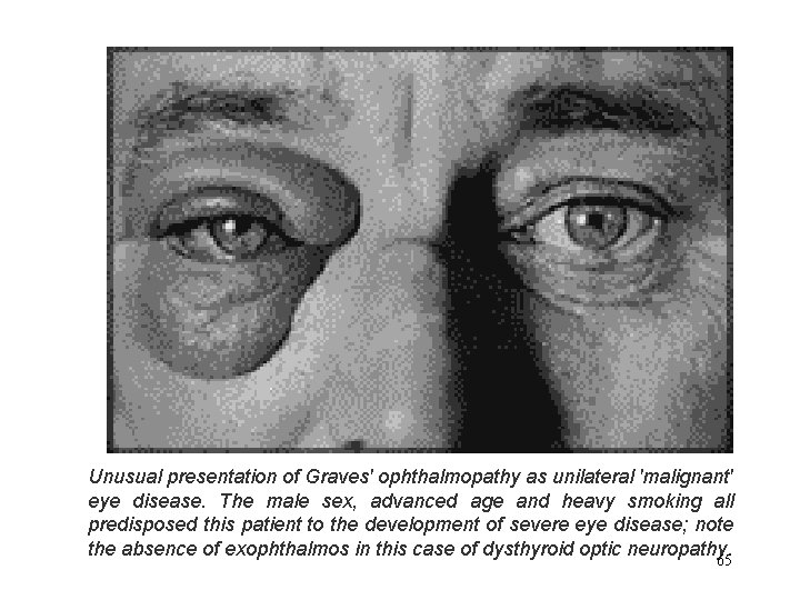 Unusual presentation of Graves' ophthalmopathy as unilateral 'malignant' eye disease. The male sex, advanced