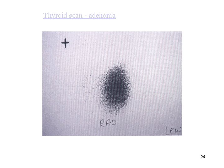 Thyroid scan - adenoma 96 