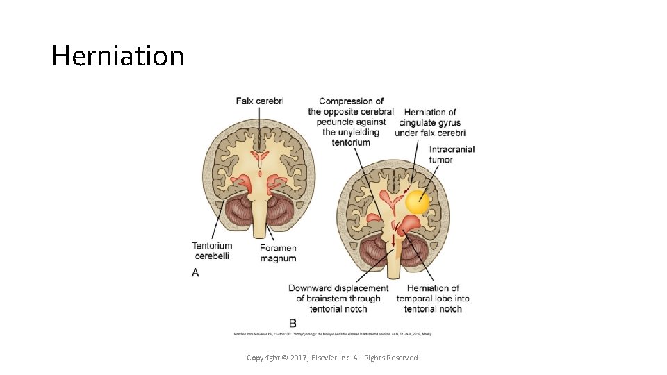 Herniation Copyright © 2017, Elsevier Inc. All Rights Reserved. Herniation Copyright © 2017, Elsevier Inc. All Rights Reserved.