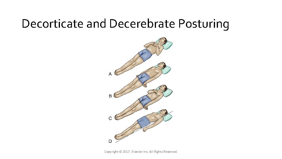 Decorticate and Decerebrate Posturing Copyright © 2017, Elsevier Inc. All Rights Reserved. Decorticate and Decerebrate Posturing Copyright © 2017, Elsevier Inc. All Rights Reserved.