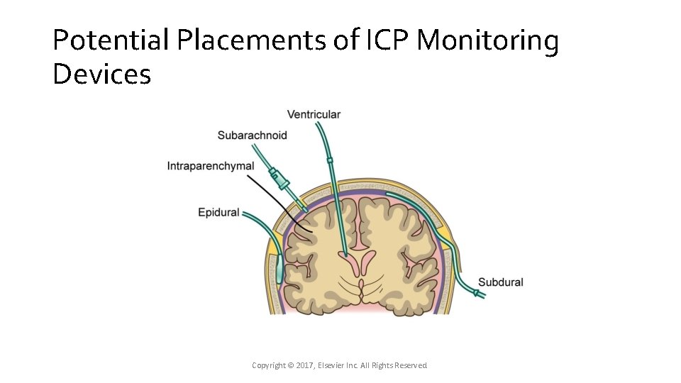 Potential Placements of ICP Monitoring Devices Copyright © 2017, Elsevier Inc. All Rights Reserved. Potential Placements of ICP Monitoring Devices Copyright © 2017, Elsevier Inc. All Rights Reserved.
