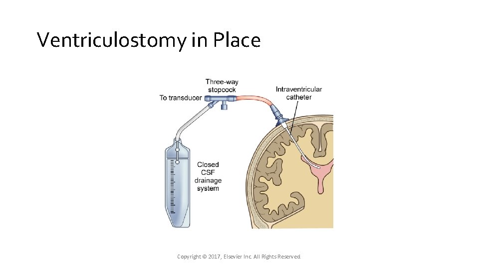 Ventriculostomy in Place Copyright © 2017, Elsevier Inc. All Rights Reserved. Ventriculostomy in Place Copyright © 2017, Elsevier Inc. All Rights Reserved.