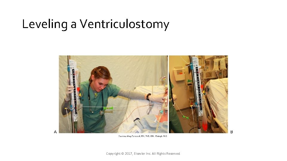 Leveling a Ventriculostomy Copyright © 2017, Elsevier Inc. All Rights Reserved. Leveling a Ventriculostomy Copyright © 2017, Elsevier Inc. All Rights Reserved.