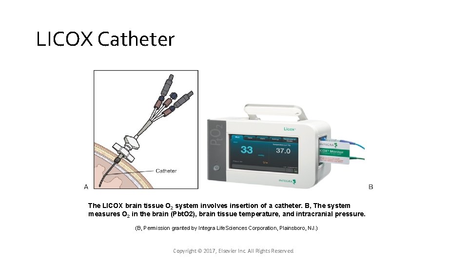LICOX Catheter The LICOX brain tissue O 2 system involves insertion of a catheter. LICOX Catheter The LICOX brain tissue O 2 system involves insertion of a catheter.
