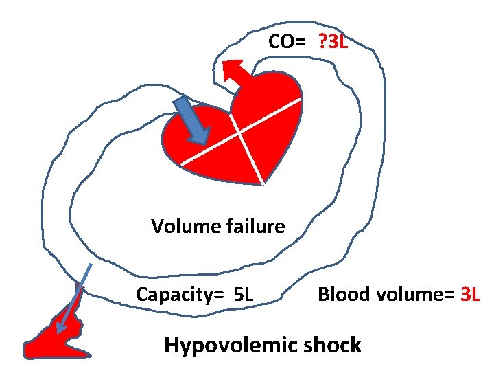 CO= ? 3 L Volume failure Capacity= 5 L Blood volume= 3 L Hypovolemic CO= ? 3 L Volume failure Capacity= 5 L Blood volume= 3 L Hypovolemic