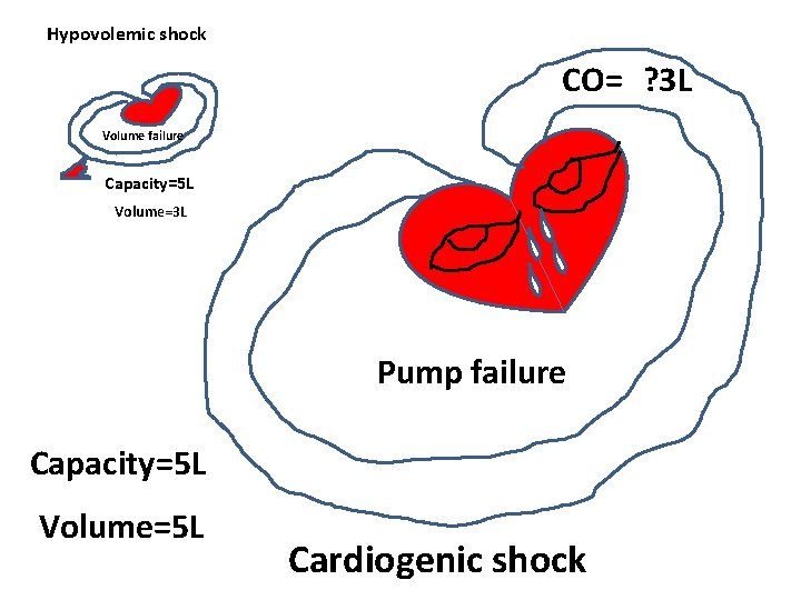Hypovolemic shock CO= ? 3 L Volume failure Capacity=5 L Volume=3 L Pump failure Hypovolemic shock CO= ? 3 L Volume failure Capacity=5 L Volume=3 L Pump failure