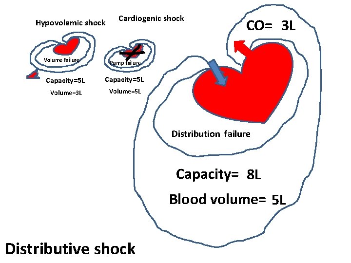 Hypovolemic shock Volume failure Cardiogenic shock CO= 3 L Pump failure Capacity=5 L Volume=3 Hypovolemic shock Volume failure Cardiogenic shock CO= 3 L Pump failure Capacity=5 L Volume=3