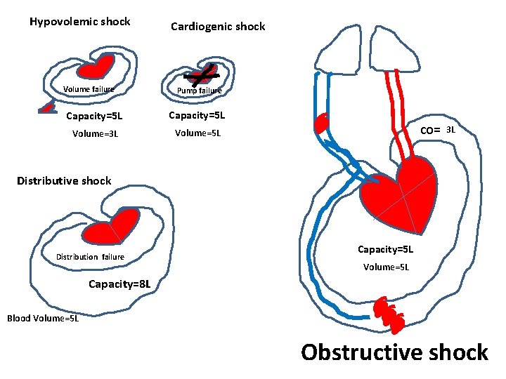 Hypovolemic shock Volume failure Cardiogenic shock Pump failure Capacity=5 L Volume=3 L Volume=5 L Hypovolemic shock Volume failure Cardiogenic shock Pump failure Capacity=5 L Volume=3 L Volume=5 L